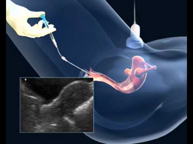 子宫切除术后代孕:是否仍然可行?