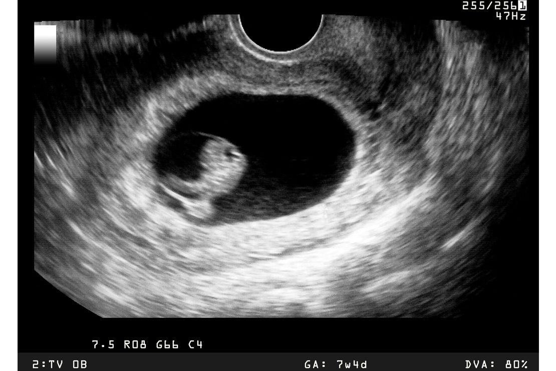 Nonviable Pregnancy Explained: Causes, Signs, and Next Steps